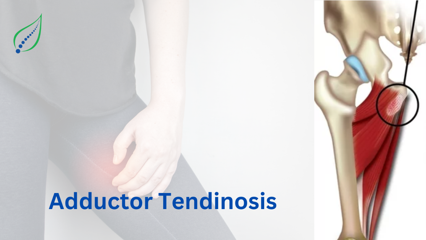 Adductor Tendinosis